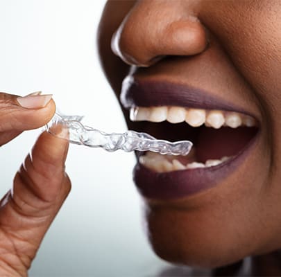 Clear Aligners, West Mall & Bloor, Etobicoke